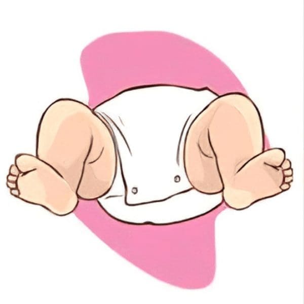 What is Arthrogryposis post