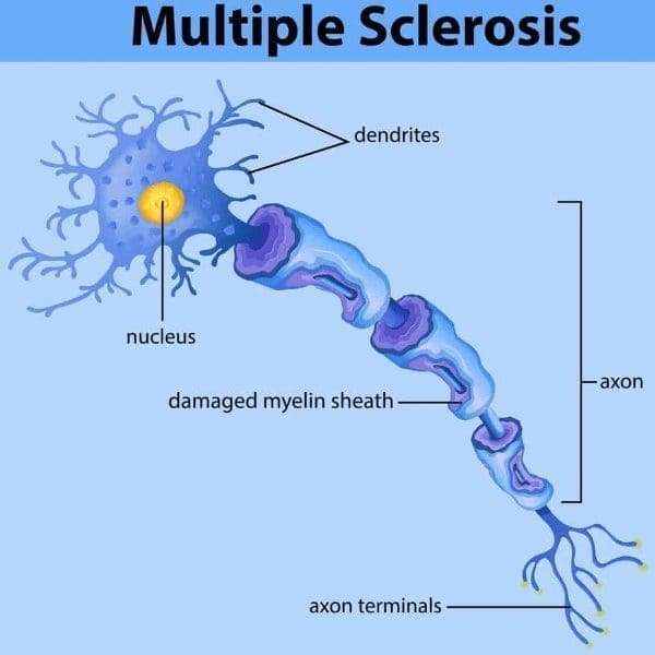 multiple sclerosis nerve damage drawing