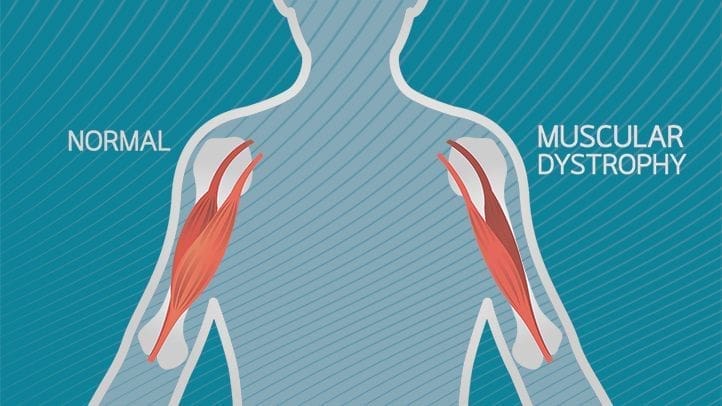 muscular dystrophy