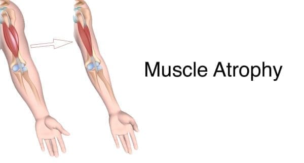 4 Muscle Atrophy