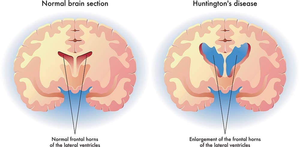huntingtons disease illustration 1f8fe4