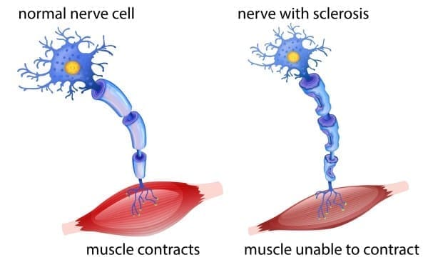 ALS Diagram